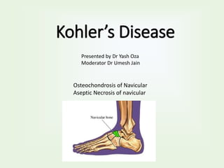 Kohler’s Disease
Osteochondrosis of Navicular
Aseptic Necrosis of navicular
Presented by Dr Yash Oza
Moderator Dr Umesh Jain
 