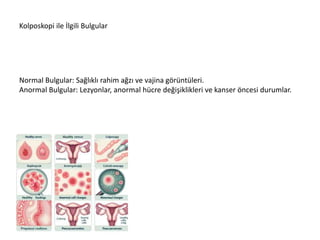 Kolposkopi Nedir Neden Ve Nas l Yap l r pptx Kolposkopi Nedir Neden Ve Nas l Yap l r pptx