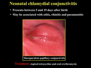 Conjunctivitis Rch 09 conjunctival infections | PPT
