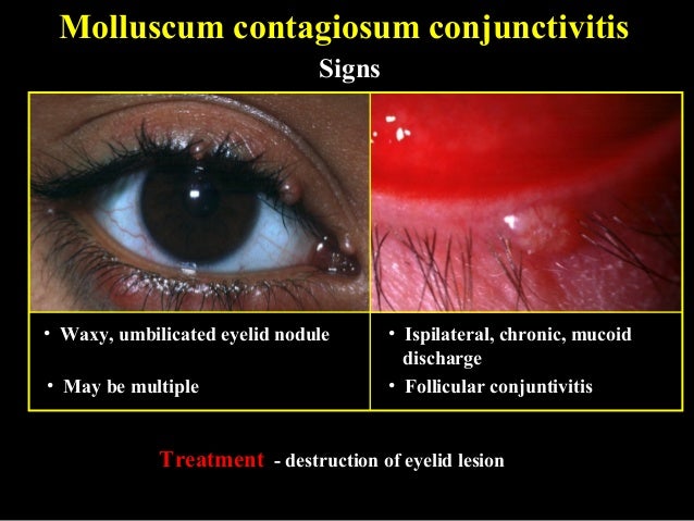 09 conjunctival infections