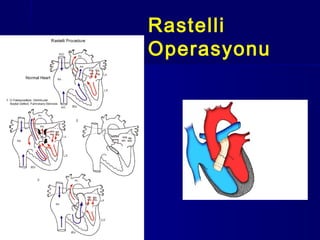 Kompleks arterial switch operasyonlar | PPT