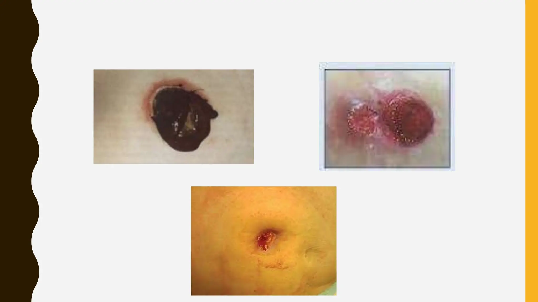 Komplikasi awal pada stoma yang bermasalah | PPTX