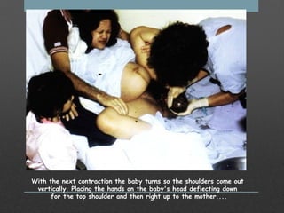                                           
With the next contraction the baby turns so the shoulders come out
vertically. Placing the hands on the baby's head deflecting down
for the top shoulder and then right up to the mother....
 