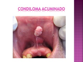 condiloma | PPT