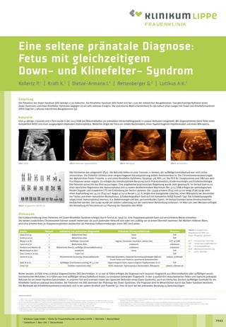 Eine seltene pränatale Diagnose:
Fetus mit gleichzeitigem
Down- und Klinefelter- Syndrom
Kollertz P.1
| Kraft K.1
| Dietze-Armana I.2
| Rettenberger G.2
| Luttkus A.K.1
1
Klinikum Lippe GmbH | Klinik für Frauenheilkunde und Geburtshilfe | Detmold | Deutschland
2
Genetikum | Neu-Ulm | Deutschland
P443
Einleitung
Die Prävalenz des Down-Syndrom (DS) beträgt 1:770 Geburten. Ein Klinefelter-Syndrom (KS) findet sich bei 1:500 der männlichen Neugeborenen. Das gleichzeitige Auftreten eines
Down-Syndroms und eines Klinefelter-Syndroms dagegen ist ein sehr seltenes Ereignis. Die statistische Wahrscheinlichkeit für die Geburt eines Jungen mit Down und Klinefeltersyndrom
(DKS) liegt bei 1:385000 männlichen Neugeborenen (9).
Kasuistik
Eine 41-jährige 2-Gravida und 0-Para wurde in der 20+5 SSW aus Altersindikation zur pränatalen Ultraschalldiagnostik in unserer Ambulanz vorgestellt. Wir diagnostizierten beim Feten einen
komplettem AVSD und einen ausgeprägten bilateralen Hydrocephalus. Weiterhin zeigte der Fetus ein mildes Nackenödem, einen hyperechogenen Papillarmuskel und einen Mikropenis.
Abb.1: AVSD	 Abb.2: bilateraler Hydrocephalus	 Abb.3: Mikropenis	 Abb.4: Nackenödem
Die Fetometrie war zeitgerecht (P50). Die Befunde ließen an eine Trisomie 21 denken, der auffällige Genitalbefund war nicht sicher
einzuordnen. Die Patientin stimmte einer vorgeschlagenen Karyotypisierung mittels Amniocentese zu. Die Chromosomenanalyse ergab
den Befund einer freien Trisomie 21 und eines Klinefelter-Syndroms, Karyotyp: 48, XXY,+21. Die PCR für Toxoplasmose und CMV aus dem
Fruchtwasser waren negativ. Es erfolgte die interdisziplinäre Beratung durch Pränatalmedizin, Kinderneurologie und Kinderkardiologie.
Die Patientin wünschte das Kind auszutragen. Eine angebotene psychosoziale Begleitung wurde nicht gewünscht. Im Verlauf kam es zu
einer deutlichen Regression des Hydrocephalus und zu einem dezelerierendem Wachstum. Bei 37+4 SSW erfolgte bei pathologischem
fetalen Doppler und suspektem CTG die Entbindung per Sectio caesarea. Der 2740g schwere (P14) und 50 cm lange (P38) Junge wies
einen Kopfumfang von 34 cm (P34) auf. Apgar 9/10/10 Na-pH 7,32. Er zeigte eine mongoloide Lidachse, einen Mikropenis bei descendier-
ten Testes und einen reduzierten Muskeltonus. Echokardiografisch fand sich ein kompletter AVSD Rastelli TypI. Die Schädelsonografie
zeigte einen Hydrocephalus internus, V.a. Balkenmangel und bds. periventrikuläre Zysten. Im Verlauf konnten keine Hirndruckzeichen
beobachtet werden. Der Junge wurde am siebten Lebenstag aus der stationären Behandlung entlassen. Im Alter von zwei Monaten erfolgte
die Vorstellung im Herzzentrum zur Planung der Operation des AVSD.
Diskussion
Die Erstbeschreibung eines Patienten mit Down-Klinefelter Syndrom erfolgte durch Ford et al. 1959 (3). Eine Doppelaneuploidie kann auf verschiedene Weise entstehen.
Die beiden zusätzlichen Chromosomen können sowohl maternaler als auch paternaler Herkunft sein oder rein zufällig von je einem Elternteil stammen. Bei Müttern höheren Alters
wird eine erhöhte Rate an Doppelaneuploidien beobachtet (6) Pränatale Fallbeschreibungen eines DKS sind selten.
Studie Fallzahl Indikation zur pränatalen Diagnostik Pränatale Ultraschallbefunde Outcome
Glass et al (4) 1 Mütterliches Alter keine TOP
Smith et al (11) 1 Mütterliches Alter keine TOP
Moog et al (8) 1 Auffälliger Ultraschall Hygrom, thorakales Hautödem, kleines Herz IUFT 19 SSW
Caron et al (2) 1 Mütterliches Alter unbekannt unbekannt
Kovaleva and Mutton (6) 8 Mütterliches Alter(5), auffällige Ultraschallbefunde(3) unbekannt unbekannt
Metzenbauer et al(7) 1 unbekannt keine TOP
Sanz-Cortes et al (10) 1 Triple Test TOP
Jeanty et al.(5) 1 Biochemisches Screening, Ultraschallbefunde Fehlendes Nasenbein, bilaterale Brachymesophalangie DigitusV,
Kurzer Femur und Humerus, prominente Seitenventrikel
Lebend, 19 Monate
Ajdin et al (1) 1 Auffälliges Erstrimesterscreening, NT 5,2 mm Hyperechogener Darm, hyperechogener Papillarmuskel im LV TOP
Unser Fall 1 Erhöhtes mütterliches Alter AVSD, bilateraler. Hydrocephalus, Nackenödem, Mikropenis Lebend 3 Monate alt
Bisher wurden 16 Fälle eines pränatal diagnostizierten DKS beschrieben. In 10 von 16 Fällen erfolgte die Diagnose nach invasiver Diagnostik aus Altersindikation oder auffälligen serum-
biochemischen Befunden. In 6 Fällen war eine auffälliger Ultraschallbefund Anlass zur invasiven pränatalen Diagnostik. In den 3 ausführlich dokumentierten Fällen sind typische pränatale
Befunde für ein Down-Syndrom beschrieben. In unserem Fall wird erstmals neben den typischen Befunden eines Down-Syndroms, auch ein klinisches Zeichen (auffälliges Genitale) für ein
Klinefelter-Syndrom pränatal beschrieben. Bei Patienten mit DKS dominiert der Phänotyp des Down-Syndroms. Die Prognose wird im Wesentlichen durch das Down-Syndrom bestimmt.
Die Merkmale des Klinefeltersyndroms entwickeln sich in der späten Kindheit und Pubertät (5). Dies ist auch bei der pränatalen Beratung zu berücksichtigen.
Literaturverzeichnis
1.	Aydin C, Eris S. An interisting prenatal Diagnosis: Double AneupoidyCase Rep Obstet Gynecol. 2013, 1-4
2.	Caron L, Tihy F, Dallaire L. Frequencies of chromosomal abnormalities at amniocentesis: over 20 years of cytogenetic analyses in one laboratory. Am J Med Genet 1999; 82:149–154.
3.	C. E. Ford, K. W. Jones, O. J. Miller et al., “The Chromosomes in a patient showing both mongolism and the Klinefelter syndrome,” The Lancet, vol. 273, no. 7075, pp. 709–710, 1959.
4.	Glass IA, Li L, Cotter PD. Double aneuploidy (48,XXY,+21): molecular analysis demonstrates a maternal origin. Eur J Med Genet 2006; 49:346–348.
5.	Jeanty C, Turner C. Prenatal diagnosis of double aneuploidy, 48, XXY,+21, and review of the literature. J Ultrasound Med 2009; 28(05):673–681
6.	Kovaleva NV, Mutton DE. Epidemiology of double aneuploidies involving chromosome 21 and the sex chromosomes. Am J Med Genet A 2005;134A(01):24–32
7.	Metzenbauer M, Hafner E, Schuchter K, Philipp K. First- trimester placental volume as a marker for chromosomal anomalies: preliminary results from an unselected population.
Ultrasound Obstet Gynecol 2002; 19:240–242.
8.	Moog U, Hamers G, Hoogland H. Prenatal sonographic diag- nosis of nuchal edema and double aneuploidy (48,XXY,+21): discrepancy between results of chorionic villi and amniotic fluid
sampling. J Clin Ultrasound 1998; 26:228–229.
9.	Rodriguez M.A. et al Down-Klinefleter syndrome ( 48,XXY,+21) in a neonate associated with congenital heart disease. Genetic ans Molecular Research 16(3) 1-7
10.	Sanz-Cortés M, Raga F, Cuesta A, Claramunt R, Bonilla- Musoles F. Prenatally detected double trisomy: Klinefelter and Down syndrome. Prenat Diagn 2006; 26:1078–1080.
11.	Smith A, Watson G, Michas J, Viersbach R, Ellwood D. Post-mortem findings in a fetus with 48,XXY,+21. Prenat Diagn 1991; 11:471–476.
Tabelle 1: Vorgeburtlich
diagnostizierte Fälle von
Down-Klinefelter Syndrom
IUFT 	= intrauteriner Fruchttod
TOP 	= Schwangerschaftsabbruch
SSL 	 = Scheitelsteißlänge
IUGR 	= Wachstumsretardierung
LV 	 = linker Ventrikel
Abb.5: Karyogramm 48,XXY+21
 