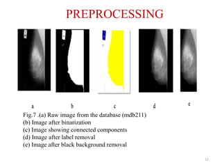 Fig.7 .(a) Raw image from the database (mdb211)
(b) Image after binarization
(c) Image showing connected components
(d) Image after label removal
(e) Image after black background removal
PREPROCESSING
12
 