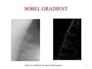 SOBEL GRADIENT
ROI
34Figure 28 (a) ROI and (b) output of Sobel gradient
 
