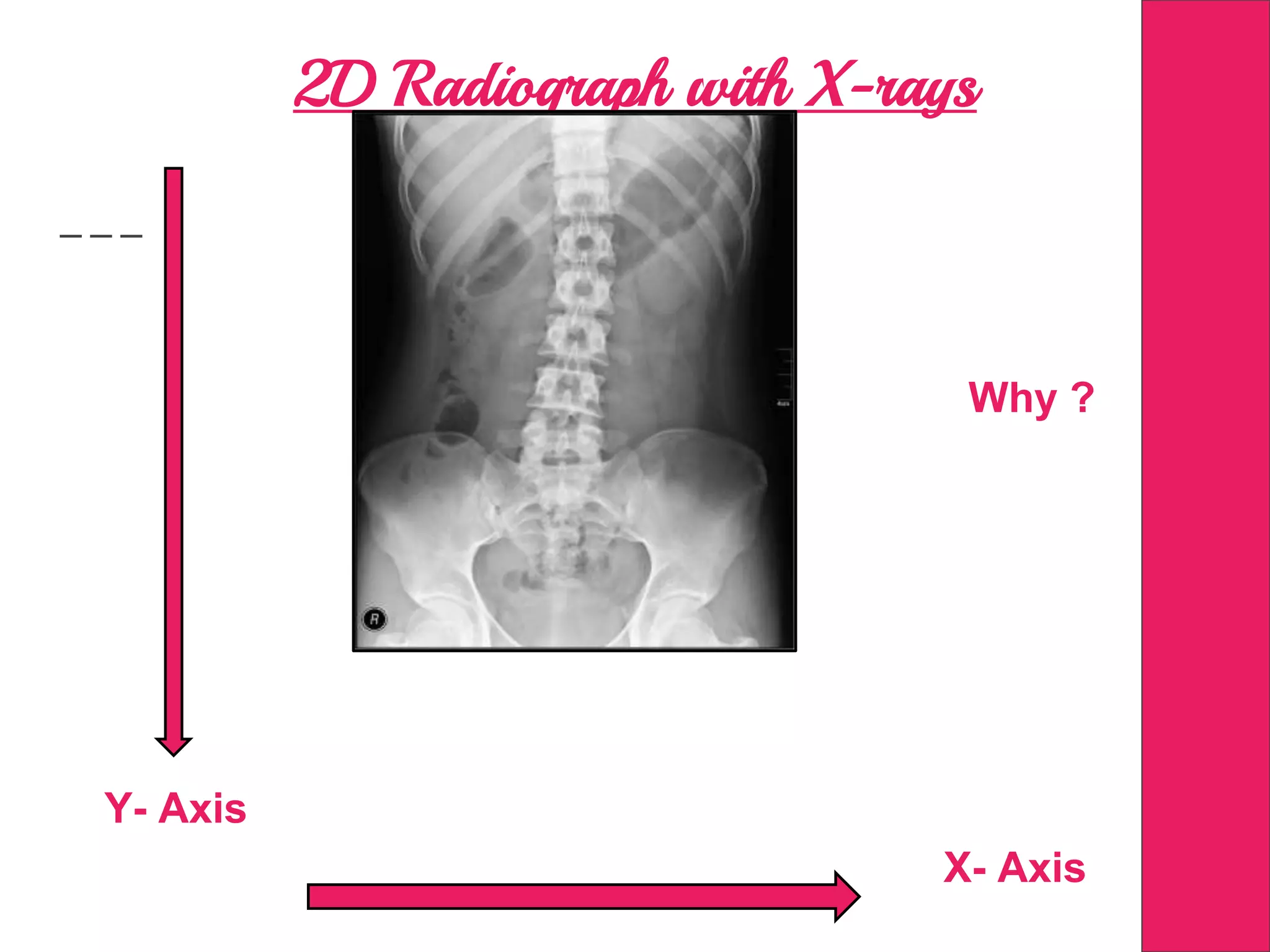 2D Radiograph with X-rays
Why ?
Y- Axis
X- Axis
 