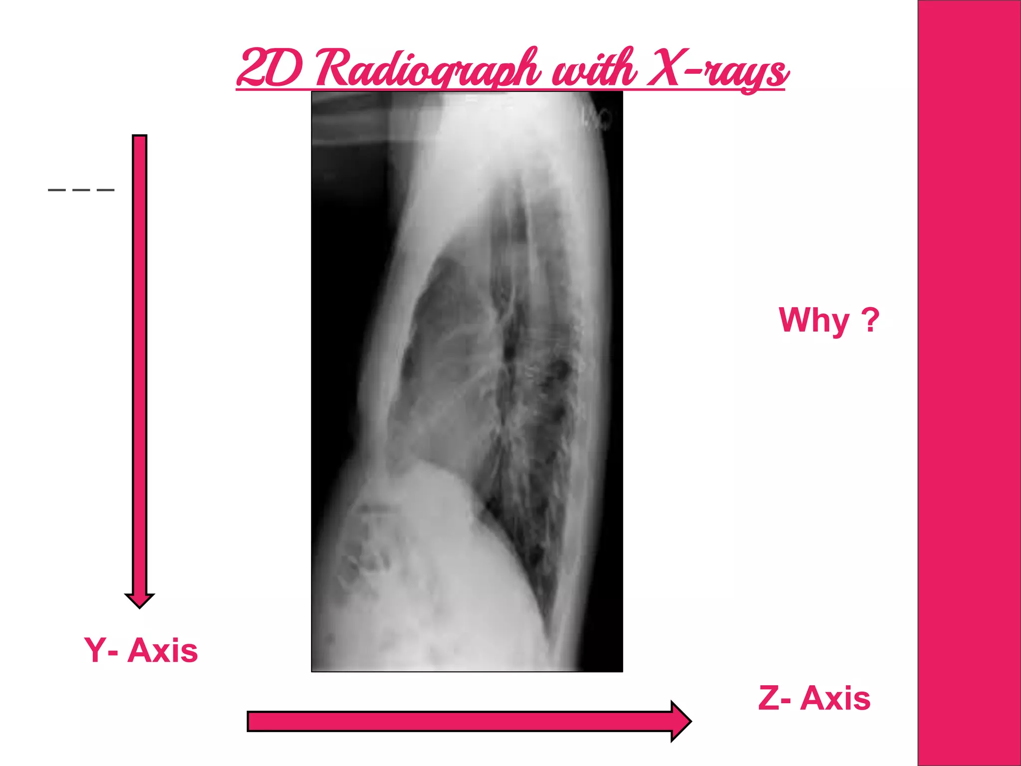2D Radiograph with X-rays
Why ?
Y- Axis
Z- Axis
 