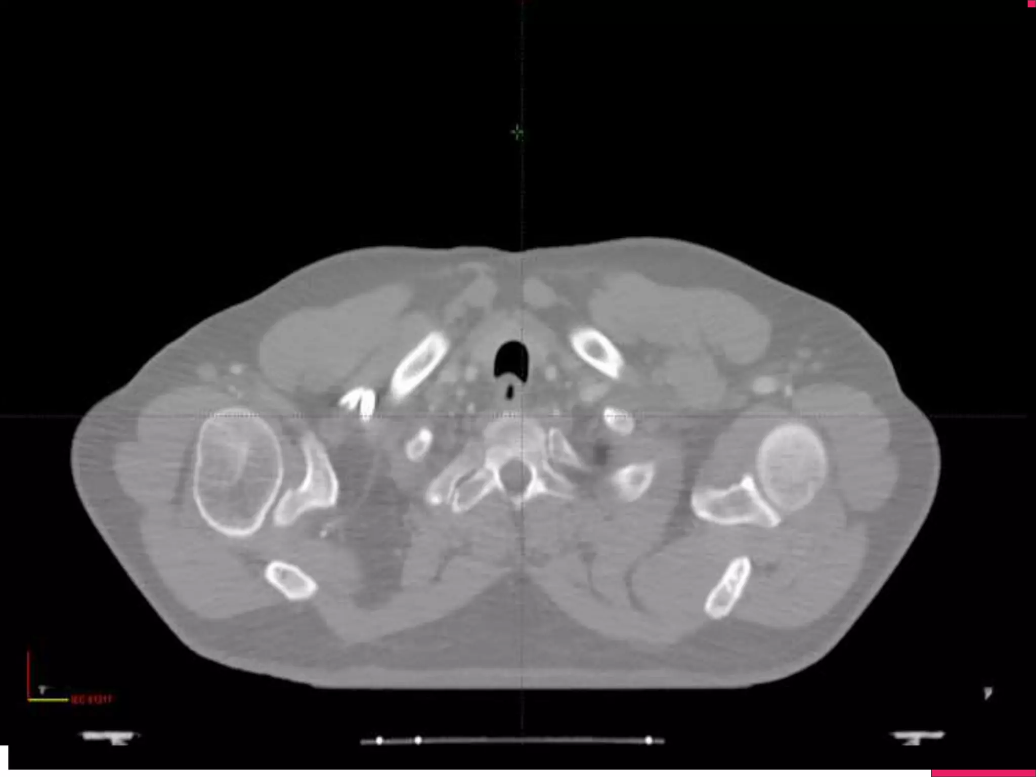 3 D Tomograph with X-rays = C.T.
Y- Axis X- Axis
 