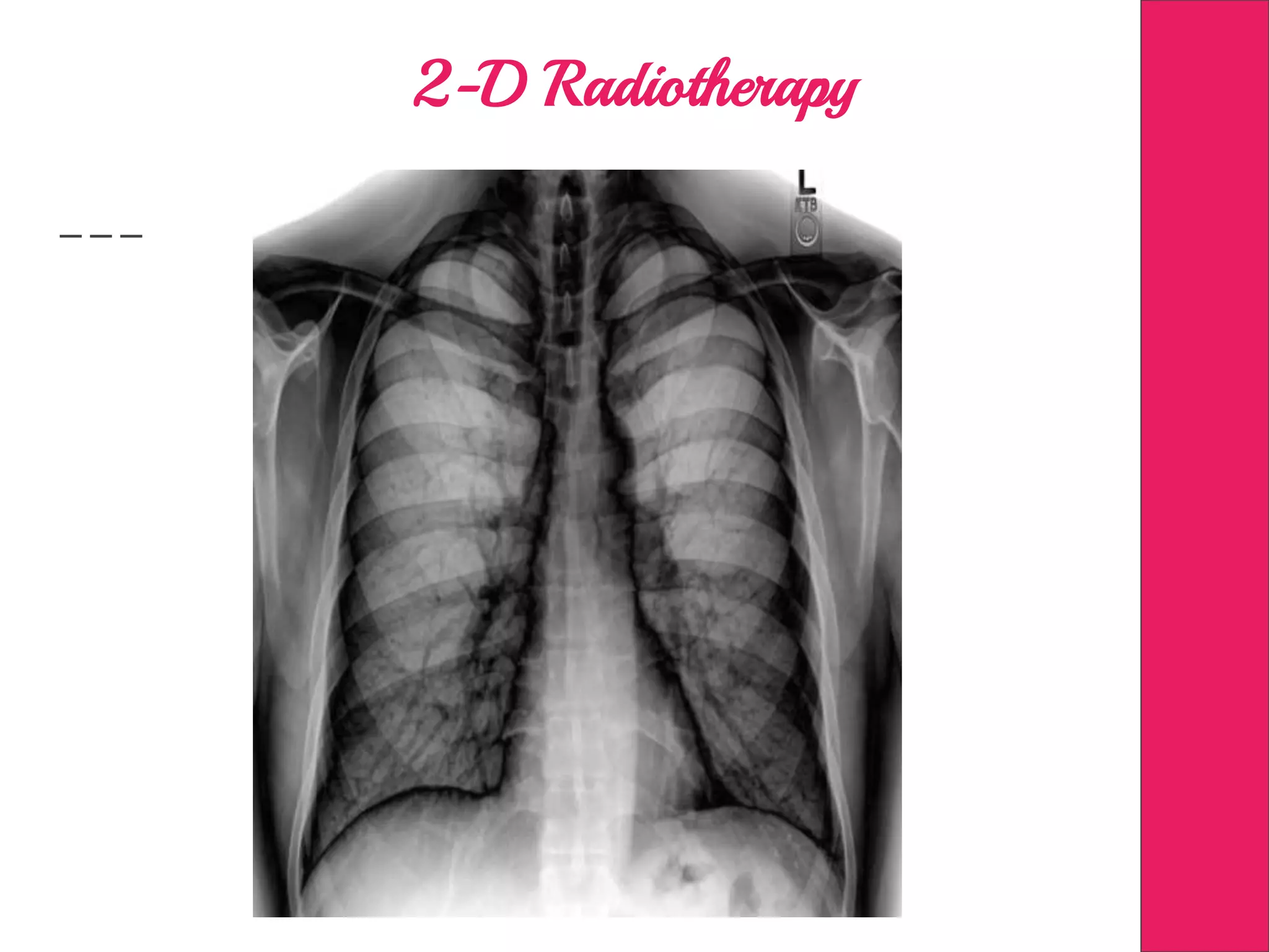 2-D Radiotherapy
 