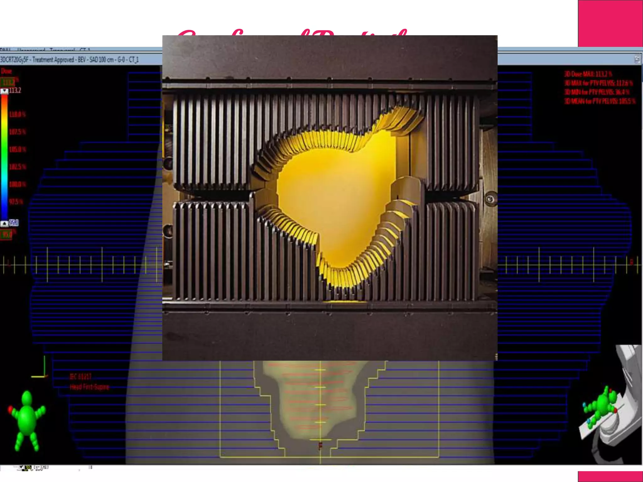 Conformal Radiotherapy
 