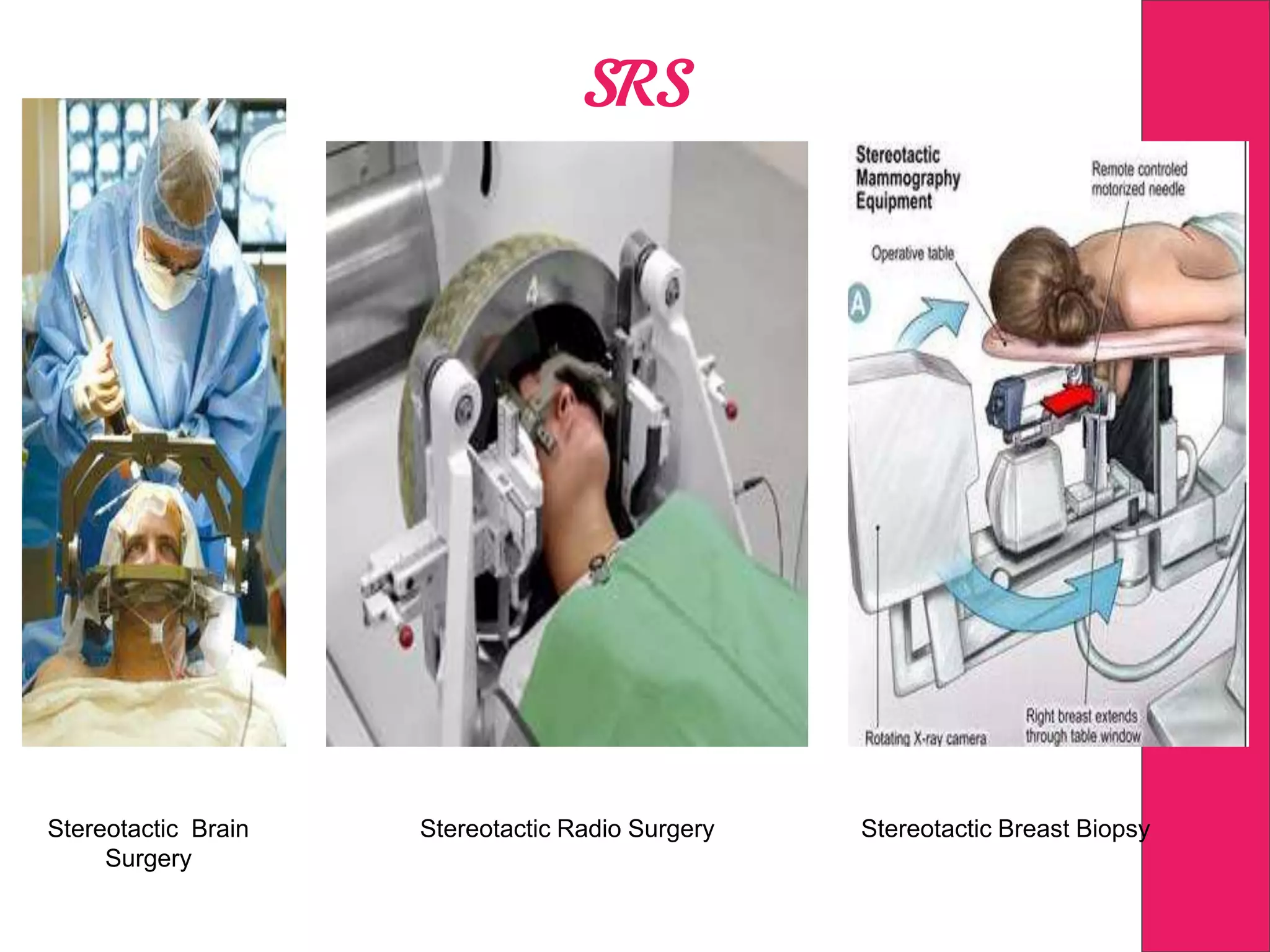 SRS
Stereotactic Brain
Surgery
Stereotactic Radio Surgery Stereotactic Breast Biopsy
 