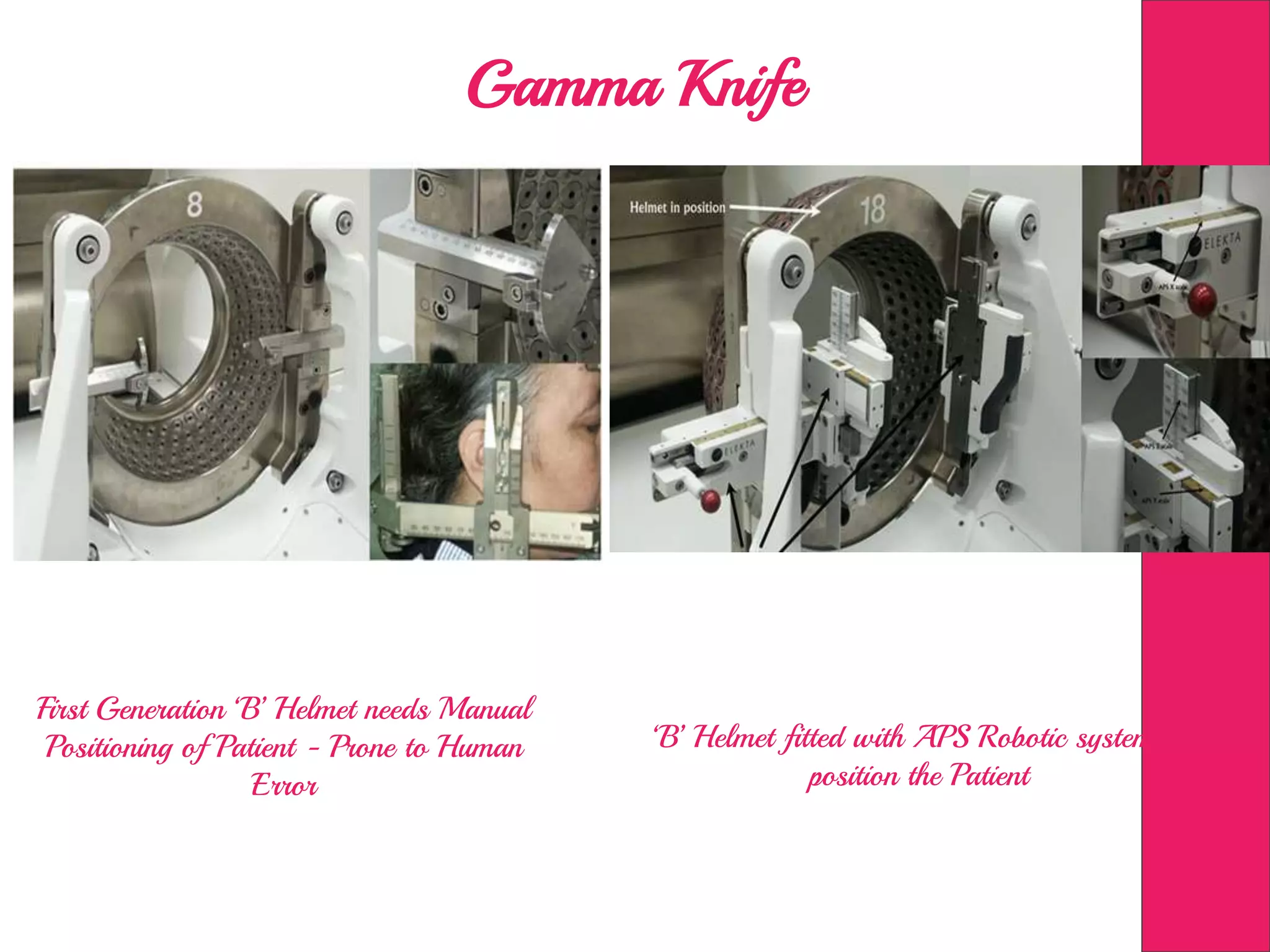 Gamma Knife
First Generation ‘B’ Helmet needs Manual
Positioning of Patient - Prone to Human
Error
‘B’ Helmet fitted with APS Robotic system to
position the Patient
 
