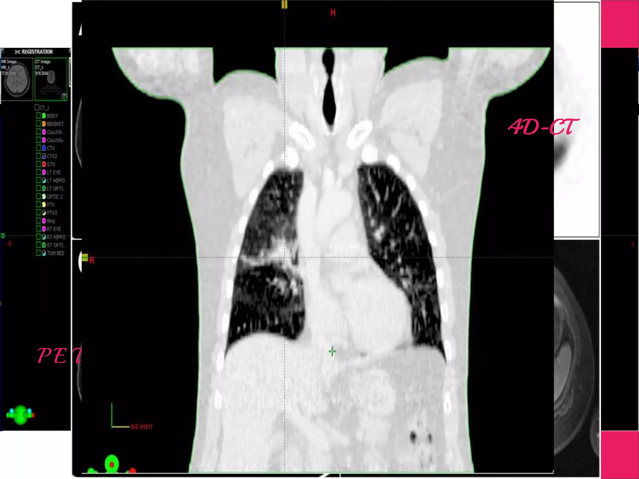 Supportive Images
Digitally Subtracted Angiograph
M R I
P E T
4D-CT
 