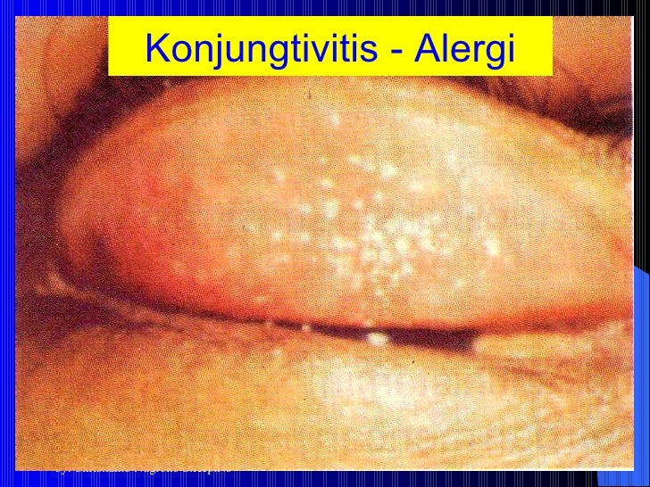 Hasil gambar untuk konjungtivitis alergi