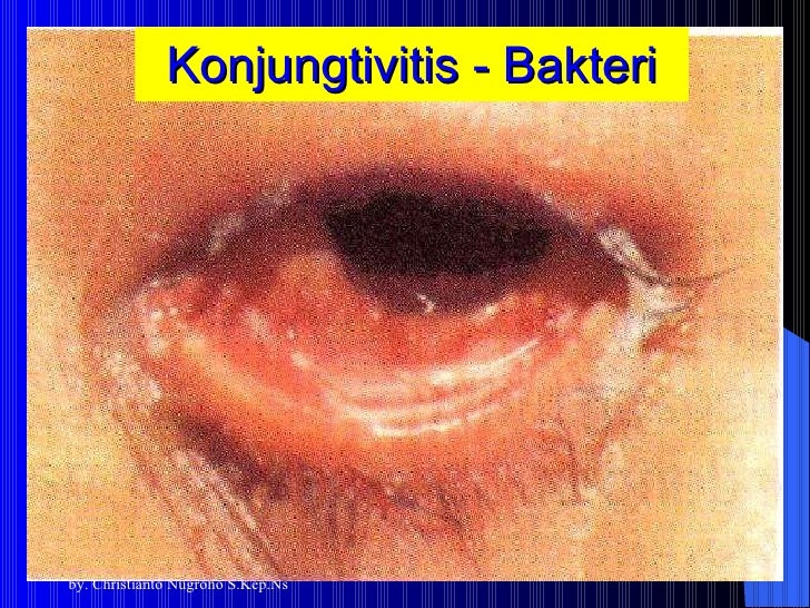 Konjungtivitis