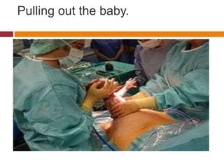 Pulling out the baby.
 