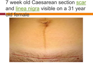 7 week old Caesarean section scar
and linea nigra visible on a 31 year
old female
 