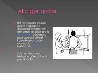  Üst abdominal cerrahi
girişim uygulanan
olgularda preoperatif
dönemde akciğer grafisi
anormalliği görülmesi,
post operatif yüksek
komplikasyon oranı
açısından bağımsız risk
faktörüdür.
 Solunum fonksiyon
testlerine göre daha iyi
prediktördür
 