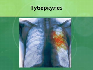 Туберкулёз 