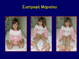 Συστροφή Μηριαίου
 