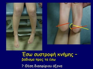 Έσω συστροφή κνήμης –
βάδισμα προς τα έσω
? Θέση διασφύριου άξονα
 