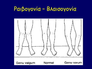 Ραιβογονία – Βλαισογονία
 