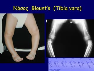 Νόσος Blount’s (Tibia vara)
 