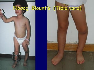 Νόσος Blount’s (Tibia vara)
 