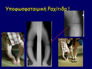 Υποφωσφαταιμική Ραχίτιδα !
 