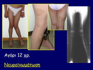 Αγόρι 12 χρ.

Νευροϊνωμάτωση
 