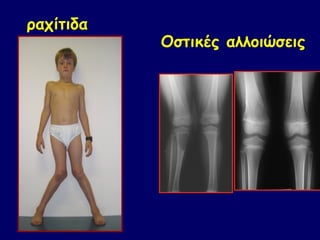ραχίτιδα
           Οστικές αλλοιώσεις
 