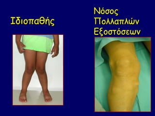 Νόσος
Ιδιοπαθής   Πολλαπλών
            Εξοστόσεων
 