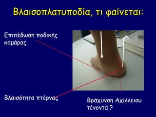 Βλαισοπλατυποδία, τι φαίνεται:

Επιπέδωση ποδικής
καμάρας




Βλαισότητα πτέρνας   Βράχυνση Αχίλλειου
                     τένοντα ?
 
