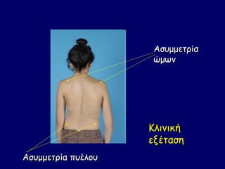 Ασυμμετρία
                     ώμων




                    Κλινική
                    εξέταση
Ασυμμετρία πυέλου
 