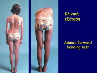 Κλινική
εξέταση




Adam’s forward
 bending test
 