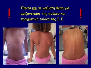 !                                   !
    Πάντα και σε καθιστή θέση για
    οριζοντίωση της πυέλου και
    πραγματική εικόνα της Σ.Σ.
 