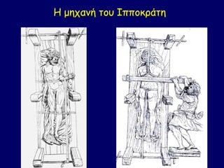 Η μηχανή του Ιπποκράτη
 