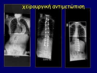 χειρουργική αντιμετώπιση
 
