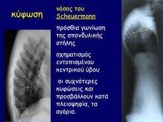 νόσος του
κύφωση   Scheuermann
         πρόσθια γωνίωση
         της σπονδυλικής
         στήλης
         σχηματισμός
         εντοπισμένου
         κεντρικού ύβου
          οι συχνότερες
         κυφώσεις και
         προσβάλλουν κατά
         πλειοψηφία, τα
         αγόρια.
 