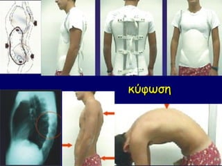 κύφωση
 