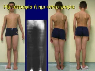Ημι-ατροφία ή ημι-υπερτροφία
 