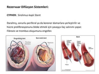 Rezervuar Difüzyon Sistemleri:
CYPHER: Sirolimus-kaplı Stent
Daralmış, sorunlu periferal ya da koroner damarlara yerleştirilir ve
hücre proliferasyonunu bloke etmek için yavaşça ilaç salınımı yapar.
Fibrozis ve trombus oluşumunu engeller.
 
