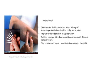 Norplant®
• Consists of 6 silicone rods with 36mg of
levonorgestrel dissolved in polymer matrix
• Implanted under skin in upper arm
• Delivers progestin (hormone) continuously for up
to five years
• Discontinued due to multiple lawsuits in the USA
Norplant® implants and subsequent insertion
 