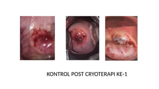 KONTROL POST CRYOTERAPI KE-1
 