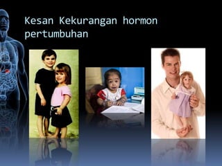 Kesan Kekurangan hormon
pertumbuhan
 
