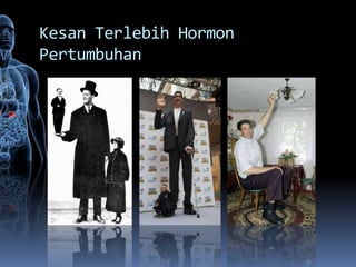 Kesan Terlebih Hormon
Pertumbuhan
 