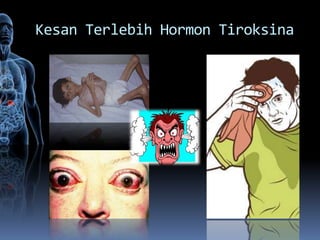 Kesan Terlebih Hormon Tiroksina
 