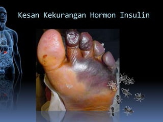 Kesan Kekurangan Hormon Insulin
 